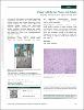 Indian J of Dermatology - 2017 - Widespread Indurated Plaques and Nodules.pdf.jpg